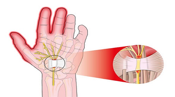 de ce iti amortesc mainile Kenalog 40 recenzii pentru artroza genunchiului
