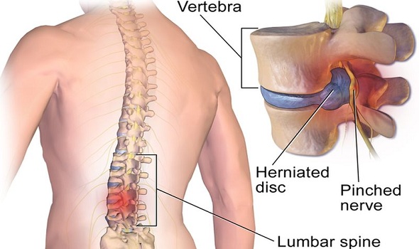 Hernie de disc cervicala operata prin metode inovatoare | bekkolektiv.com