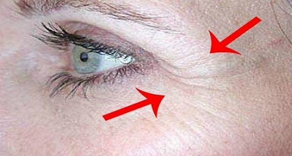 tratament naturist pentru riduri in jurul ochilor